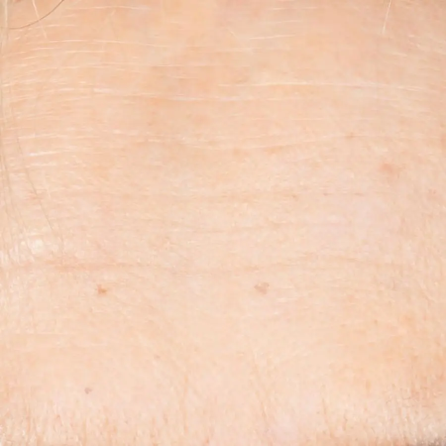 The same forehead, day 90